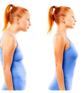 درمان عارضه گردن رو به جلو | تمرین برای عارضه سر به جلو